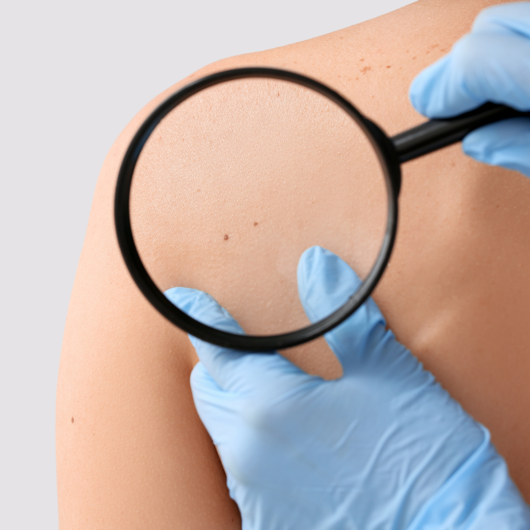 May: Skin Cancer Awareness Month