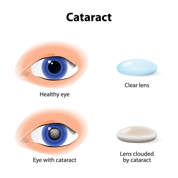 June: Cataract Awareness Month